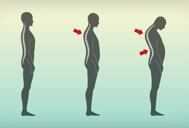 Gù lưng ảnh hưởng đến sức khỏe và hệ hô hấp